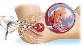 На сроке от 6 до 12 недель женщины делают хирургический аборт (кюретаж), Всемирная организация здравоохранения признала его опасным для здоровья