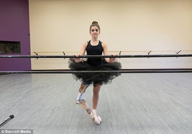 Девочка с протезом ноги успешно занимается балетом